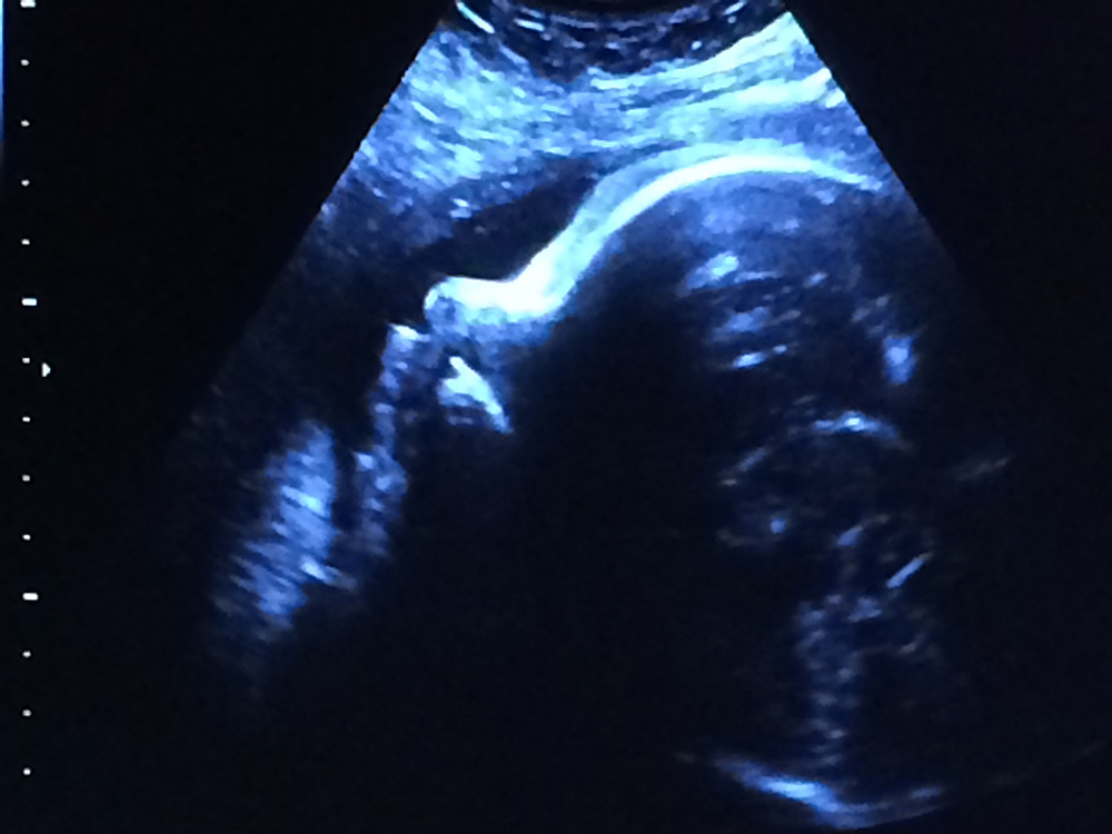 Ultrasound