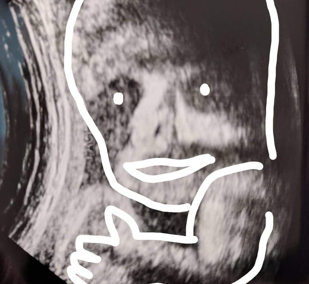 Ultrasound